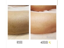 メンズ髭脱毛、脚脱毛お任せください！