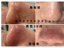 ウルト アルティメイトスキン(ULT ultimate skin)/お肌の汚れ気になりませんか？？