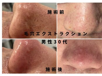 ウルト アルティメイトスキン(ULT ultimate skin)/お肌の汚れ気になりませんか??