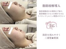 メゾンリュバン 梅田店(Maison Ruban)/脂肪撃退アンプル導入｜小顔