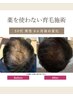 【育毛促進カウンセリング】頭に視線がいってしまうあなた限定!