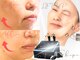 ナイア(naia)の写真/特許取得の顔筋トレーニング《テラボーラー》×最新型の《脂肪分解ポレーション》でたるみ改善＆小顔◎