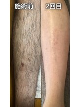 ゲッカ(GEKKA)/メンズ脚脱毛効果