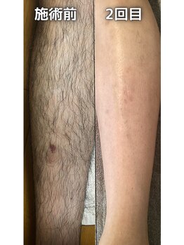 ゲッカ(GEKKA)/メンズ脚脱毛効果