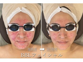 ギンレイ(GINREI)/ 【Before → After】