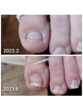 爪切り屋 足楽/欠損爪