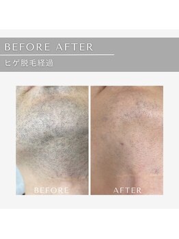 ジール(GIILL)/ヒゲ脱毛経過