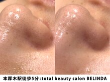 ベリンダ(BELINDA)/毛穴洗浄ハイドロスプラッシュ