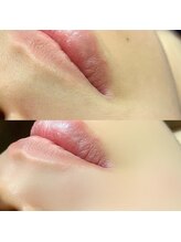 ビヨウシツチャーリー/うぶ毛撲滅！