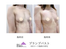 バイオビューティー 神戸本店(Bio Beauty)/プランプバスト　6回コース症例
