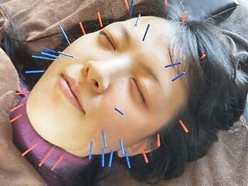 やまざき鍼灸整骨院の写真/美容鍼とヒト幹細胞液のW効果でお悩みも解決◎小顔・ほうれい線・シミ改善・たるみケアに