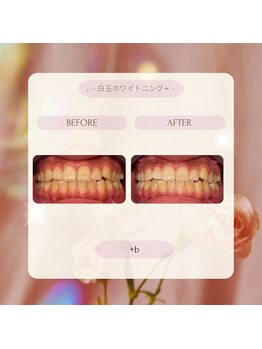プラスビー 2号店(+b)/ホワイトニングビフォーアフター