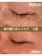 ココロ(COCORO)/目の周りのシミケア