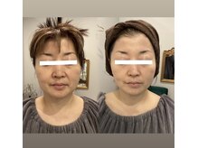 アンジェリック ビーナス(Angelic Venus)/筋膜リリース　超小顔コース