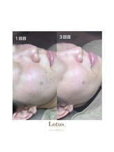 シミケア専門サロン Lotus. 千早香椎店【シミ/シワ/毛穴/小顔】/シミケア【千早/香椎】