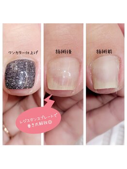 ミミカケルソラ(mimi×sora)/巻き爪補正☆ワンカラー