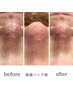 【新規男女/花粉や皮脂対策で透明肌へ】全顔3D毛穴洗浄体験¥5500