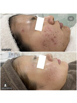 ニキビケア研究所 所沢店/実績数に自信あり!