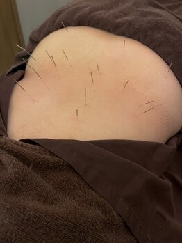 ハリマジック 代官山(HARI MAGIC)/【代官山/鍼灸/美容鍼】