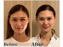 整体ラルース 中目黒(LALUZ)/20代 女性 頭蓋骨小顔矯正　変化