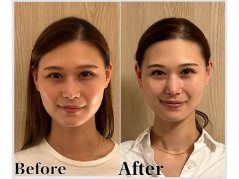 整体ラルース 中目黒(LALUZ)/20代 女性 頭蓋骨小顔矯正 変化