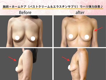 ロットプラス(Lot Plus)/バストアップ症例【F→Gカップ】