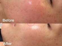 サロンヴェアリー 広尾(salon vary)/赤み、日焼け、乾燥、酒さ、花粉