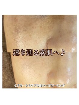 ハリサロンドオフ 西梅田店(hari salon de off)/シミケアビフォーアフター
