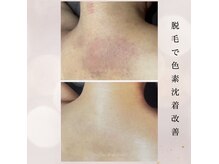 肌トラブルでお悩みの方もお肌に優しい脱毛で美肌ケアも同時に◎