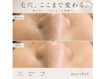 マリベル(maribel)の雰囲気（ララピールで肌育。シミ、くすみ、ニキビに◎）