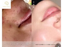 ブロッサム(Blossom)の雰囲気(ハーバルモアハーブピーリング肌根本改善に◎敏感肌にも◎剥ける)