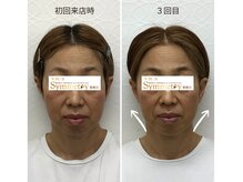 なさき整骨院プラスシンメトリー 豊橋店/50代女性の小顔ビフォーアフター