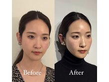 コルミチョン サロン(骨美整 salon)/Before・After &nbsp;15回施術