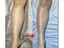 ジュエリーボディー(Jewelry body)/ふくらはぎのむくみ