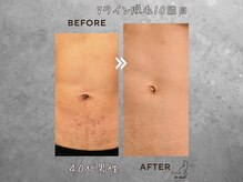 ル シャ/メンズ脱毛/毛穴洗浄/ヘッドスパ