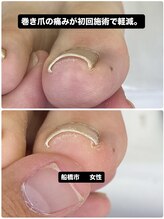 巻き爪じゅん 千葉駅前店/巻き爪の痛み軽減！話題の施術