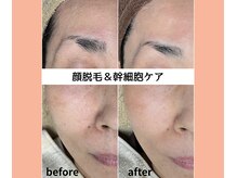 ベルミーランド 浜松天王/フェイシャルBefore→After