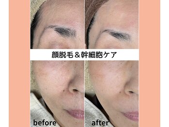 ベルミーランド 浜松天王/フェイシャルBefore→After