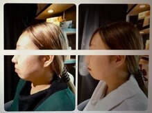 セントセシリア/レモンボトルフェイシャルで小顔