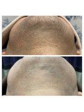 アンジェリーナ/40代/ヒゲ脱毛/6回