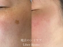エステティック リベル キョウト 京都駅前店(Esthetic Liber Kyoto)/魔法のシミケア