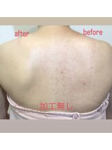 イルス(Ilus)/カミソリシェービングで白艶美肌