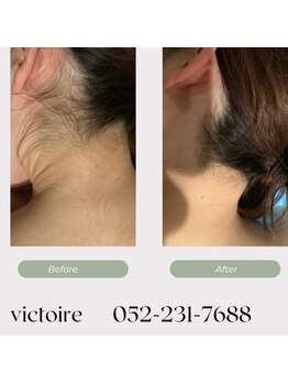 ヴィクトワール(Victoire)/産毛にも反応する最新脱毛機器