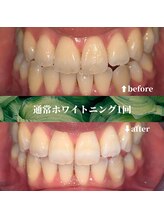 フタバ 天神大名店(futaba)/初回ホワイトニングbefore after