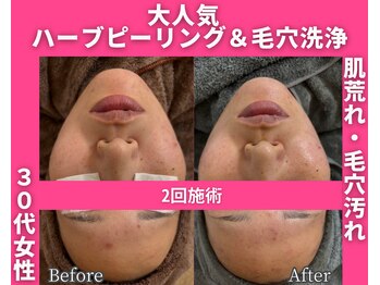 イーラボ 池袋店(e-LABO)/毛穴洗浄×国産ハーブピーリング