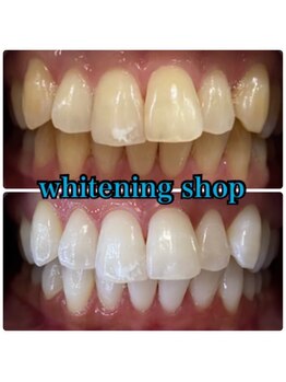 ホワイトニングショップ 山形店(Whiteningshop)/ムラなく照射♪