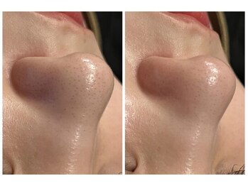 オリーブ コクブンジ(Olive kokubunji)/ハーブピーリング｜毛穴