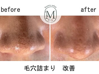 ミヨン(Miyong)/毛穴詰まり　改善