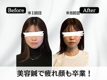 ハリユナイテッド 原宿鍼灸 整体院(HALI UNITED)/美容鍼で疲れ顔卒業！