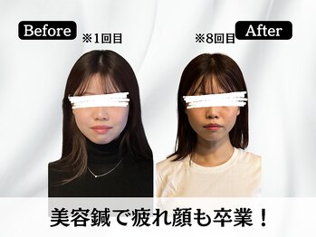 ハリユナイテッド 原宿鍼灸 整体院(HALI UNITED)/美容鍼で疲れ顔卒業!